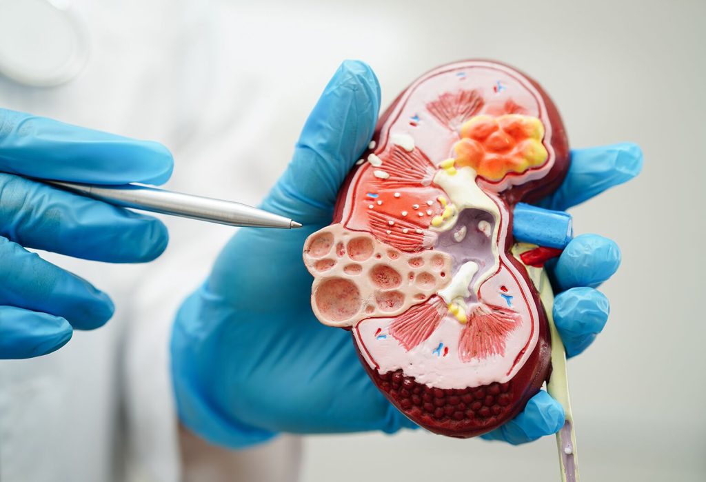 Understanding Kidney Transplant and Life After the Procedure